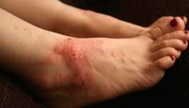 allergic-contact-dermatitis